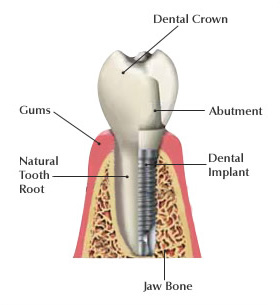 dental-implant-tooth
