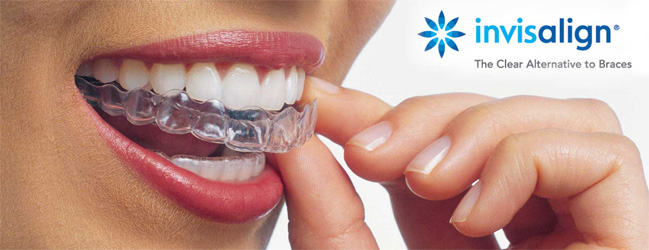 What-is-Invisalign