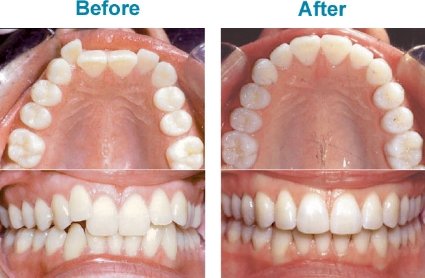 how-does-invisalign-work-before-after
